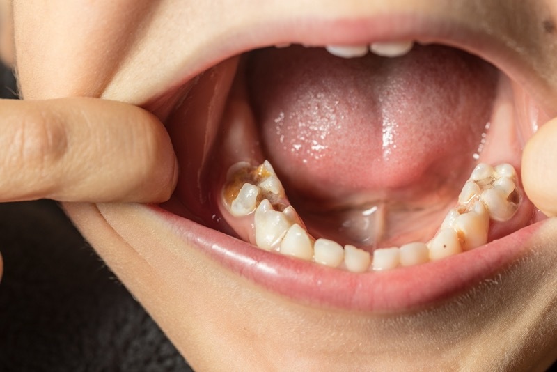 Main image for Town’s rotten record on kids’ tooth decay