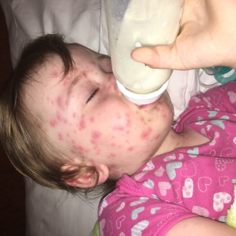 Main image for Family stranded in Corfu after daughter diagnosed with severe chickenpox